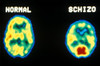 PET scans, normal and schizophrenic Poster Print by Science Source - Item # VARSCI6T0910