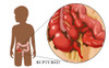 Ruptured Appendix Poster Print by Monica Schroeder/Science Source - Item # VARSCIBW0182