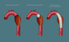 Aortic Aneurysm Stent, Illustration Poster Print by Monica Schroeder/Science Source - Item # VARSCIJB0639