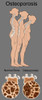 Osteoporosis Poster Print by Gwen Shockey/Science Source