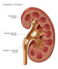 Kidney Stones, Illustration Poster Print by Monica Schroeder/Science Source - Item # VARSCIJB0675