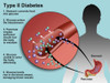 Type 2 Diabetes Poster Print by Gwen Shockey/Science Source - Item # VARSCIBZ1732