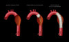 Aortic Stent, Illustration Poster Print by Monica Schroeder/Science Source - Item # VARSCIJB5226