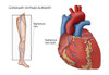 Coronary Bypass Surgery Poster Print by Monica Schroeder/Science Source - Item # VARSCIJC2612
