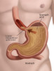 Stomach Acid Reflux Poster Print by Spencer Sutton/Science Source
