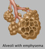 Alveoli with Emphysema Poster Print by Gwen Shockey/Science Source - Item # VARSCIBZ3609