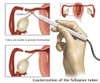 Cauterization of the Fallopian Tubes Poster Print by Gwen Shockey/Science Source - Item # VARSCIJA0524