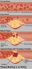 Plaque in Artery Poster Print by Gwen Shockey/Science Source