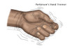 Hand Tremor, Illustration Poster Print by Monica Schroeder/Science Source - Item # VARSCIJC0709