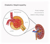 Kidney Damaged by Diabetes Poster Print by Monica Schroeder/Science Source - Item # VARSCIJA7824