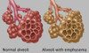 Normal vs. Emphysematous Alveoli Poster Print by Gwen Shockey/Science Source - Item # VARSCIBZ3610