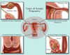 Ectopic Pregnancy Poster Print by Gwen Shockey/Science Source - Item # VARSCIBZ7428