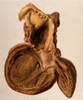 Diseased Heart, Aneurysm, Illustration, 1897 Poster Print by Science Source - Item # VARSCIJA1801