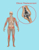 Elbow Joint Replacement, Illustration Poster Print by Gwen Shockey/Science Source - Item # VARSCIJB8459