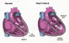 Healthy Heart vs. Heart Failure Poster Print by Spencer Sutton/Science Source - Item # VARSCIBY8013