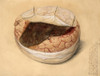 Blood Clot, Brain, Illustration 1869 Poster Print by Science Source