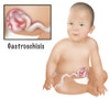 Baby with Gastroschisis Poster Print by Gwen Shockey/Science Source - Item # VARSCIBY2272