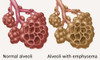 Normal vs. Emphysematous Alveoli Poster Print by Gwen Shockey/Science Source - Item # VARSCIBZ3639
