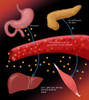Type I Diabetes Poster Print by Monica Schroeder/Science Source - Item # VARSCIBY4057