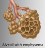 Alveoli with Emphysema Poster Print by Gwen Shockey/Science Source - Item # VARSCIBZ3662