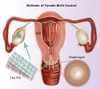 Methods of Female Birth Control Poster Print by Gwen Shockey/Science Source - Item # VARSCIBZ3614
