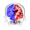 Normal / Alzheimer's Brain Comparison Poster Print by Spencer Sutton/Science Source - Item # VARSCIBU5172