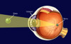 Cataract Poster Print by Spencer Sutton/Science Source - Item # VARSCIBW0802