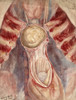 Aneurysm, Aortic Arch, Illustration, 1896 Poster Print by Science Source
