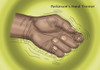 Hand Tremor, Illustration Poster Print by Monica Schroeder/Science Source