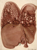 Liver and Diaphragm, Cancer Growths, 1890 Poster Print by Science Source - Item # VARSCIJA1812