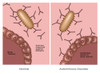 Normal Immune System & Autoimmune Disease Poster Print by Gwen Shockey/Science Source - Item # VARSCIJC1033