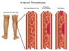 Leg Blood Clots Poster Print by Gwen Shockey/Science Source - Item # VARSCIBY1904