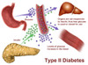 Type 2 Diabetes Poster Print by Gwen Shockey/Science Source - Item # VARSCIBZ1698