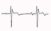 Normal ECG Poster Print by Science Source - Item # VARSCIBW6644