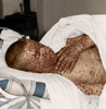 Smallpox Victim Poster Print by Science Source - Item # VARSCIBY4454