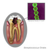 Oral Infection of Streptococcus Oralis Poster Print by Gwen Shockey/Science Source - Item # VARSCIJB3231