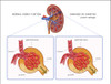 Normal and Diabetes-Damaged Kidneys, Illustration Poster Print by Monica Schroeder/Science Source - Item # VARSCIJA7822