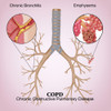 Chronic Obstructive Pulmonary Disease Poster Print by Monica Schroeder/Science Source - Item # VARSCIBV8592