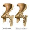 Osteoporotic & Normal Bone Poster Print by Spencer Sutton/Science Source - Item # VARSCIJB9168