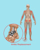 Ankle Joint Replacement, Illustration Poster Print by Gwen Shockey/Science Source - Item # VARSCIJB8506