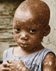 Child With Smallpox Poster Print by Science Source - Item # VARSCIJA1392