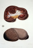 Diseased Kidney Sections, Illustration, 1827 Poster Print by Science Source - Item # VARSCIJA1802