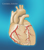 Coronary Arteries Poster Print by Monica Schroeder/Science Source - Item # VARSCIJB7855