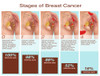 Breast Cancer Stages, Illustration Poster Print by Gwen Shockey/Science Source - Item # VARSCIJC0969