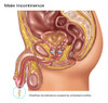 Overflow Incontinence in Male Anatomy Poster Print by Gwen Shockey/Science Source - Item # VARSCIJB6970