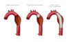 Aortic Aneurysm Stent, Illustration Poster Print by Monica Schroeder/Science Source - Item # VARSCIJB0647