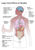Long Term Effects of Alcohol Poster Print by Spencer Sutton/Science Source - Item # VARSCIBY8006