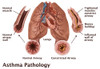 Asthma Pathology Poster Print by Gwen Shockey/Science Source - Item # VARSCIJA0508