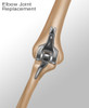 Elbow Joint Replacement, Illustration Poster Print by Gwen Shockey/Science Source - Item # VARSCIJB8463