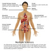 Symptoms of Multiple Sclerosis Poster Print by Gwen Shockey/Science Source - Item # VARSCIBZ3641